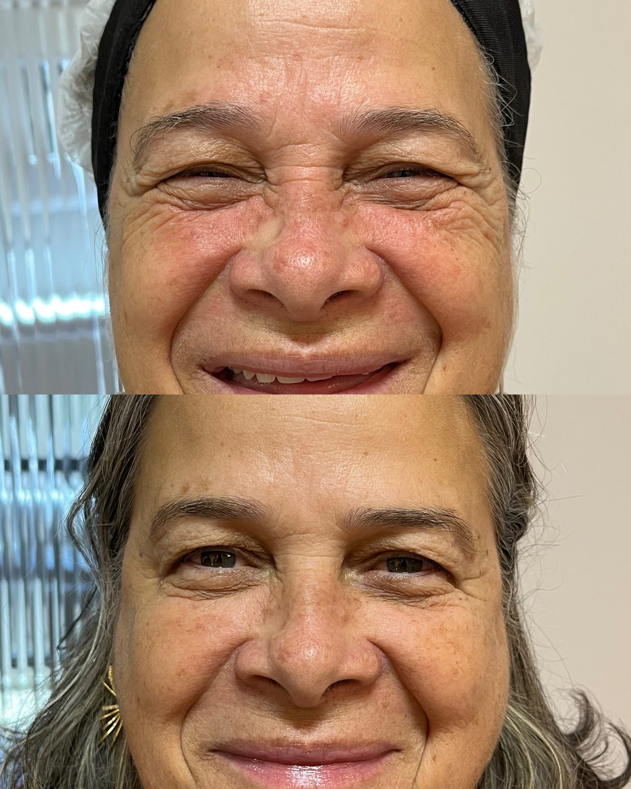 Resultado antes e depois, Harmonização Facial