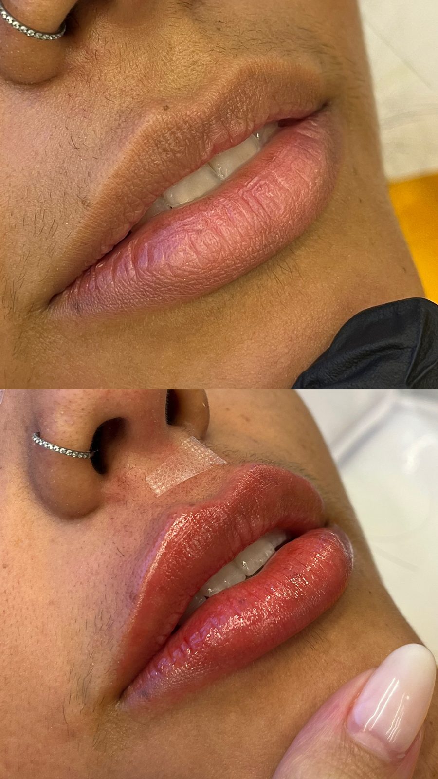 Resultado antes e depois, Harmonização Facial