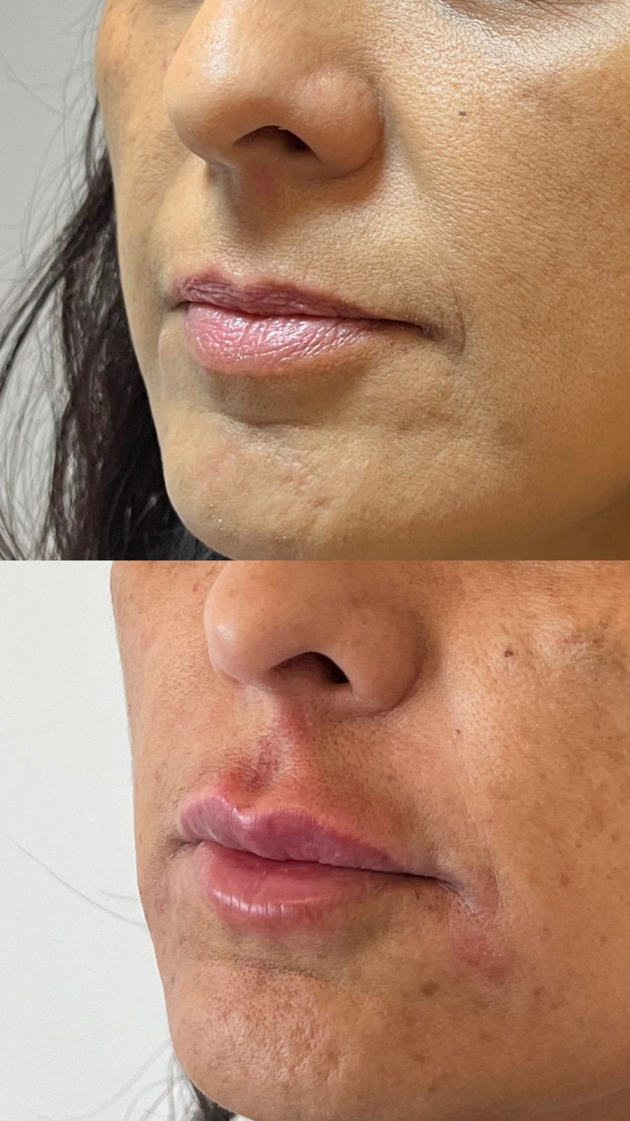 Resultado antes e depois, Harmonização Facial