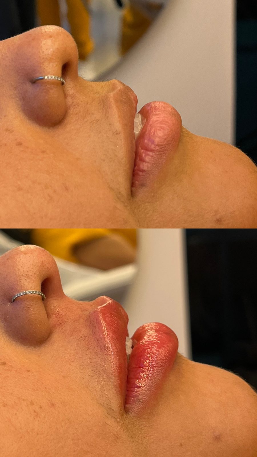 Harmonização Facial Full Face
