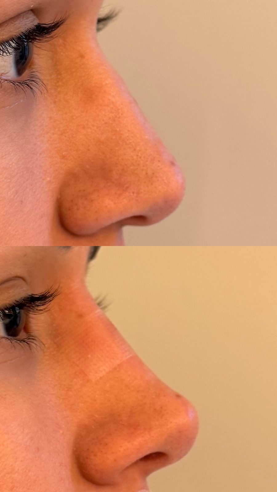 Harmonização Facial Full Face