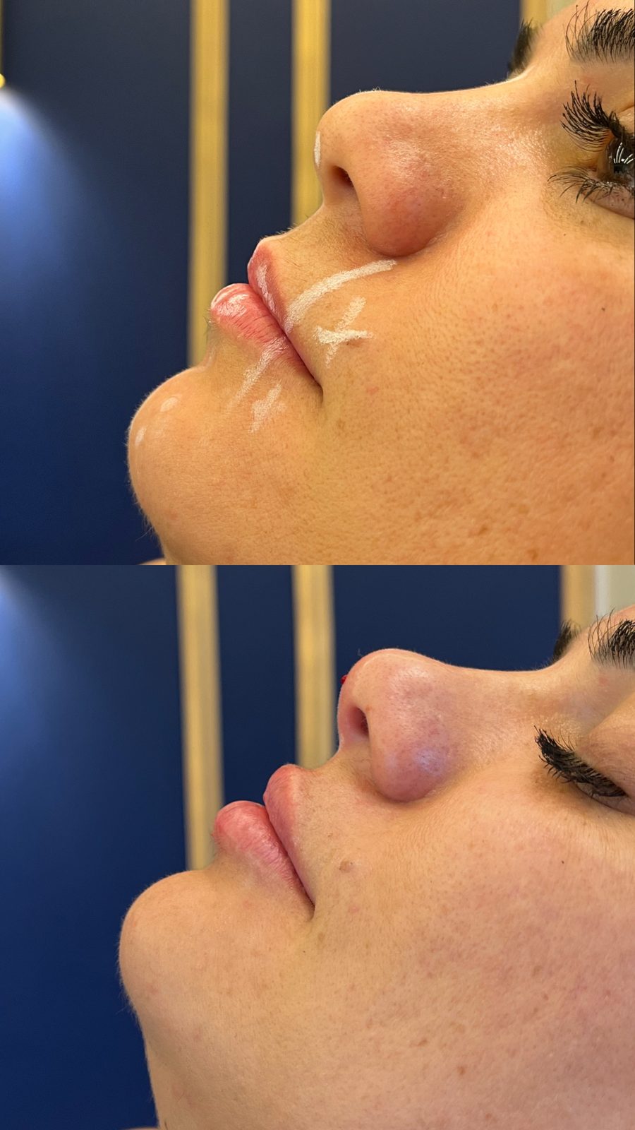 Harmonização Facial Full Face